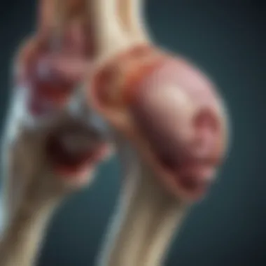 Bone Metastases in Prostate Cancer Illustration depicting bone metastases in prostate cancer