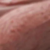 Detailed diagram of eczema skin structure